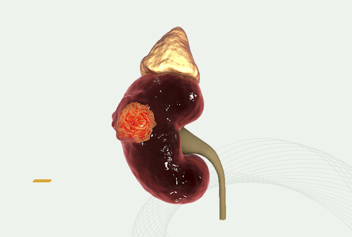 Treatment of kidney cancer