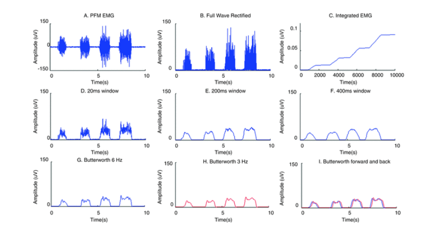 Electroneuromyography (ENMG) of the pudendal nerve: what does it demonstrate?