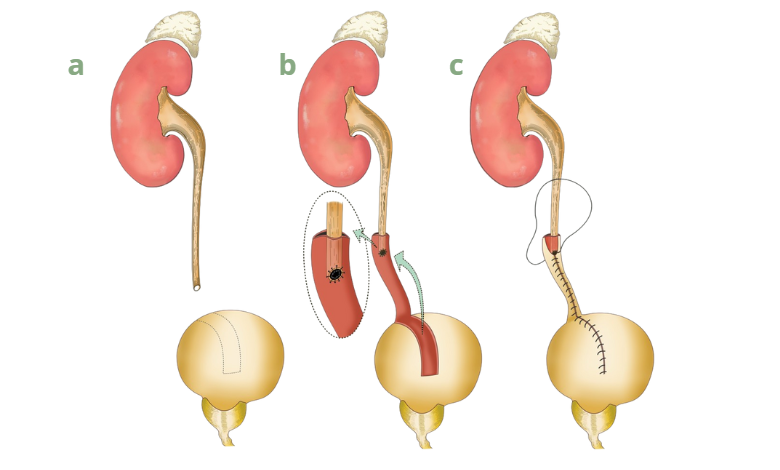 Reconstruction of the Ureter