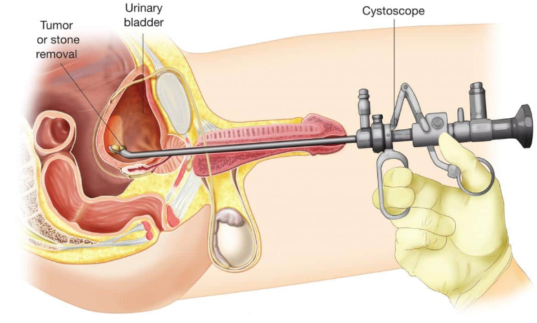 Cystoscopy