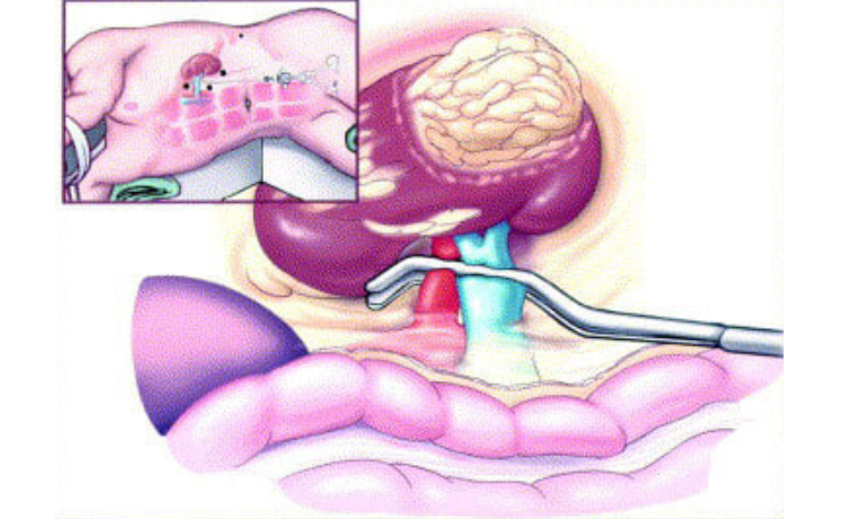 Radical kidney removal