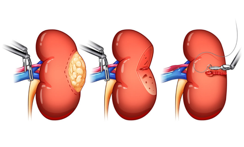 Kidney tumor resection