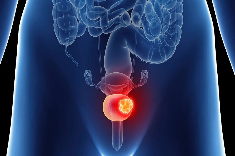 Bladder tumor